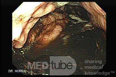 Gastric Cancer - 84 Years-Old Male