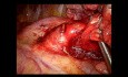 Left Upper Lobectomy fissureles technique (NON EDITED, LIVE SURGERY)