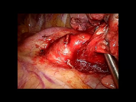 Left Upper Lobectomy fissureles technique (NON EDITED, LIVE SURGERY)