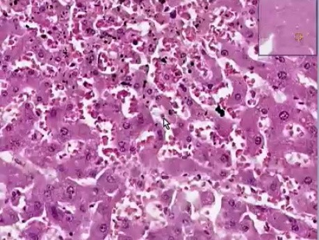Congestion and hemorrhage - Histopathology of lung and liver