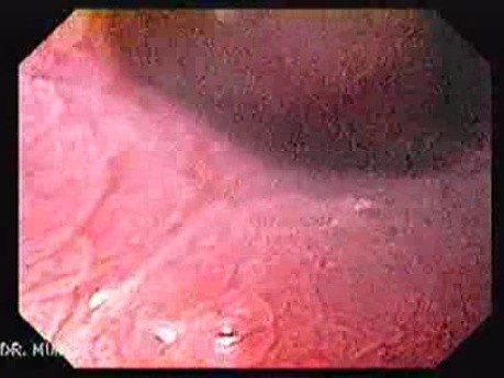 Longstanding gastroesophageal reflux disease -magnifying endoscopy (4 of 7)