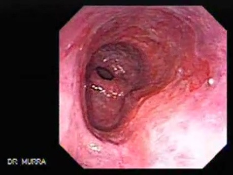 Barrett's Esophagus of long segment (15 of 24)