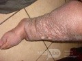 Elephantiasis nostras verrucosa on the legs with morbid
 obesity (3 of 5)