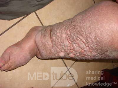Elephantiasis nostras verrucosa on the legs with morbid
 obesity (3 of 5)