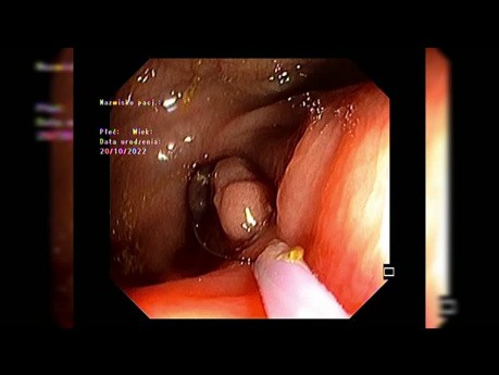 EMR of Periappendiceal Lesion after Partial Circumferential Mucosal Incision