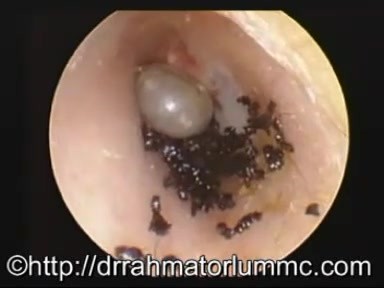 Ectoparasite in The Ear Canal