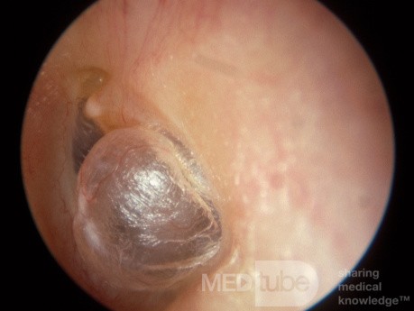 Pulsion Hernia Tympanic Membrane