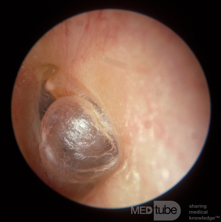 Pulsion Hernia Tympanic Membrane