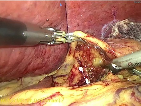 Lap Wedge Gastrectomy with Intracorporeal Suture for GIST at Lesser Curvature