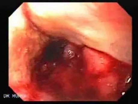 Synchronous Cancer Gastric and Esophageal (8 of 9 )