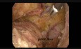 Laparoscopic Low Anterior Resection for Rectal Cancer