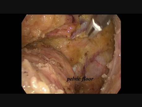 Laparoscopic Low Anterior Resection for Rectal Cancer