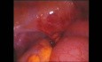 Gynecological emergencies acute abdomen adenocarcinoma ileum 2002