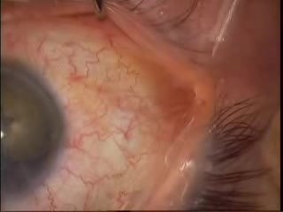 Phacoemulsification - White Cataract