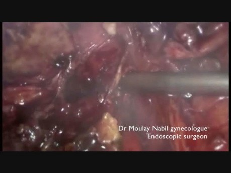 Rectal Shaving, Ureterolysis for Deep Infiltrating Endometriosis
