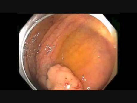 Colonoscopy Channel Quiz 12