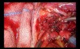 Intrapericardial Uniportal VATS Double Sleeve Lobectomy Using a Proximal Vascular Clamp