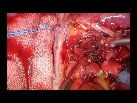Intrapericardial Uniportal VATS Double Sleeve Lobectomy Using a Proximal Vascular Clamp