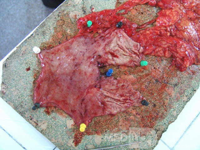 Small Gastric Adenocarcinoma of the Diffuse Ring Cell (13 of 19)