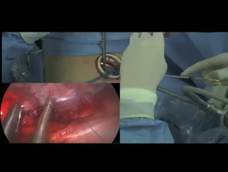 Uniportal VATS Right Main Bronchus Sleeve Resection