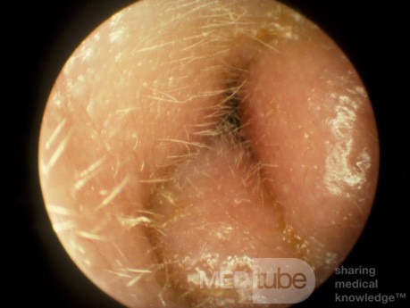 Severe Acute Otitis Externa with Meatal Occlusion