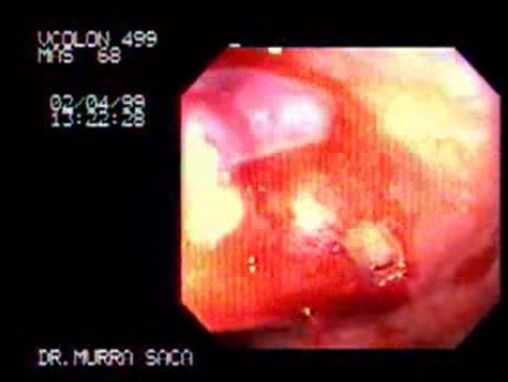 Acute Diverticulitits - Perforation