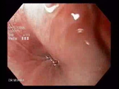 Narrow Band Imaging (NBI) of the Digestive Tract