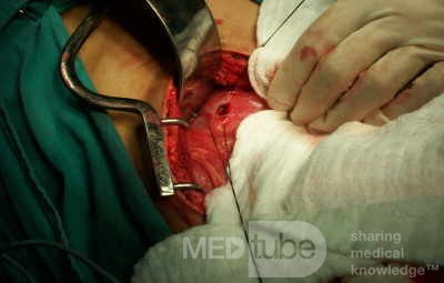 Perforated Gastric Ulcer