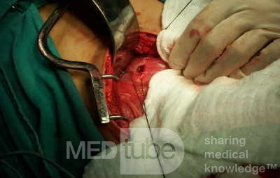 Perforated Gastric Ulcer
