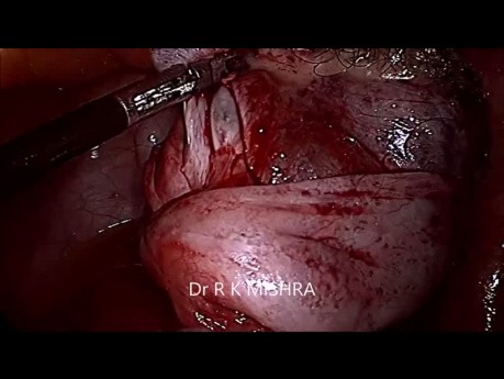 Bilateral Dermoid Cyst
