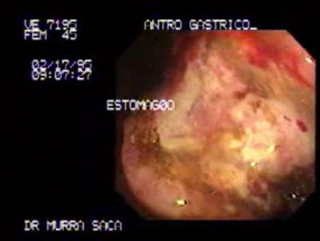 Cancer of the Antrum