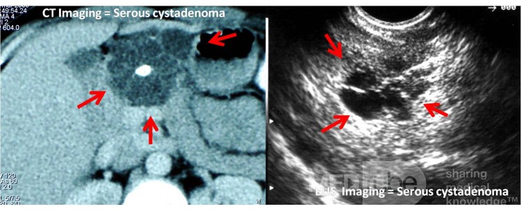 A typical image of pancreatic serous cystadenoma