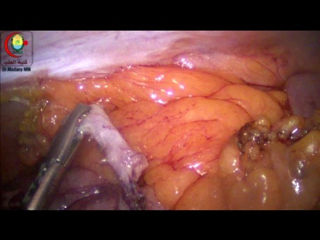 Evacuation Of The Contents Of The Appendix With Suction