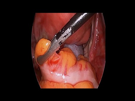 Acute Abdomen Torsion Teratoma