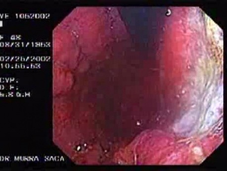 Gastroscopy - Patient With The Epigastric Pain