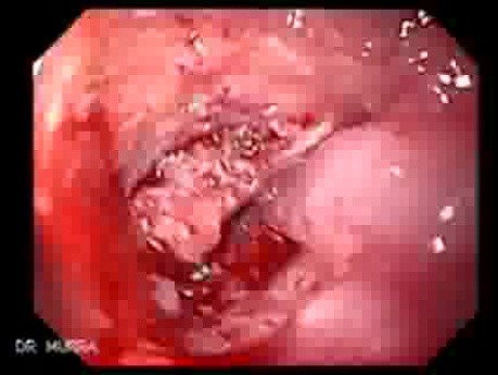 Middle Third Esophageal Cancer - Endoscopic View