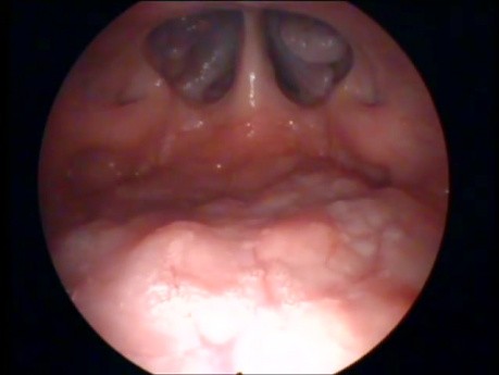 Transoral Nasopharyngoscopy Technique-The View of Nasopharynx