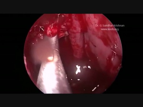 Endo Maxillectomy