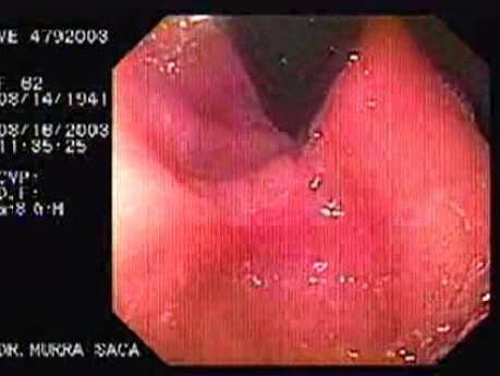 Intraluminal Endoscopic Suturing - 62 Years-Old Female