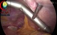 Handling to Lock the Liver Retractor Gently