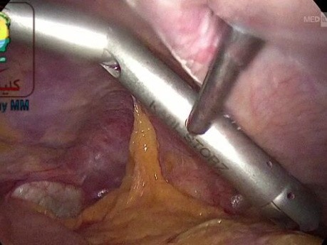 Handling to Lock the Liver Retractor Gently