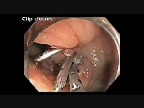 EMR Scar Clip