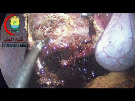 Do you Prefer to do Ablation to the Remaining Epithelial Lining of The Cyst After Deroofing or not