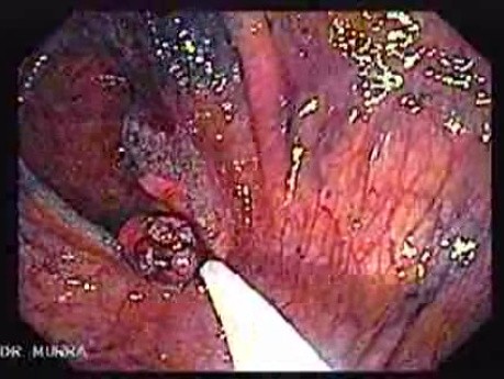 Sessile Tubulovillous Adenoma (9 of 13)