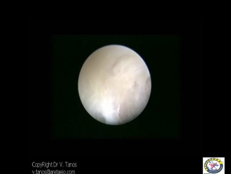 Cervix And Endometrial Cavity Obliterated By Adhesions  