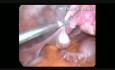 Laparoscopic Surgery for Paraovarian Cyst