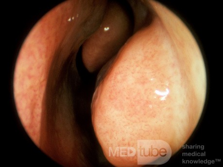 Enlarged Inferior Turbinate 2 [after decongestant application]