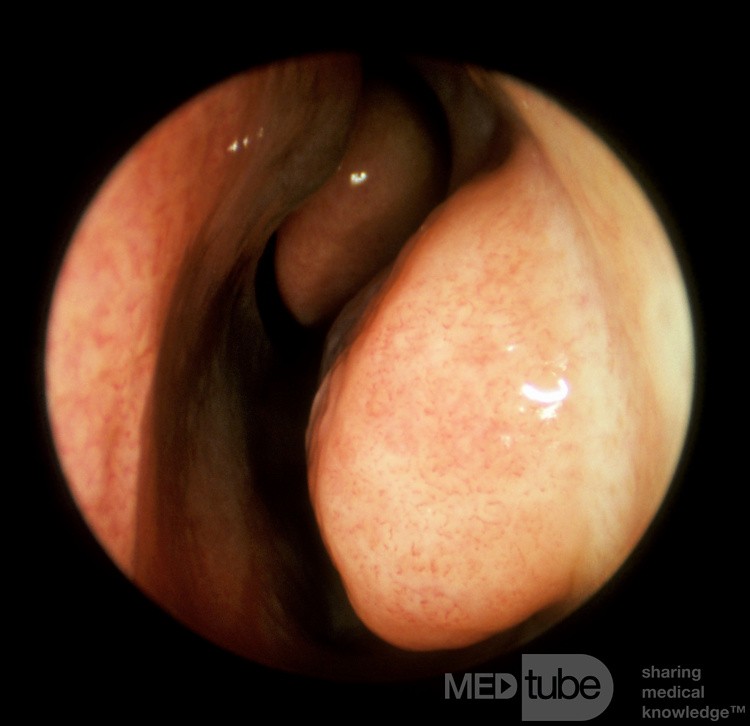 Enlarged Inferior Turbinate 2 [after decongestant application]
