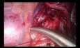 Uniportal VATS Lower Posterior Anatomic Segmentectomy (S10)