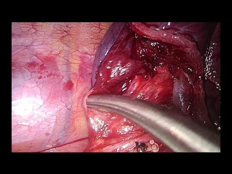 Uniportal VATS Lower Posterior Anatomic Segmentectomy (S10)